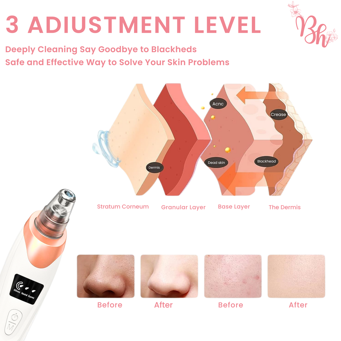 5-in-1 Blackhead Remover Vacuum | Pore Cleaner for Acne, Pimples & Whiteheads | Powerful Suction for Deep Facial Cleansing